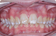 Patient 7.  Problem: Jaw position  Treatment type: Herbst appliance and braces 