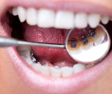 Hidden lingual braces