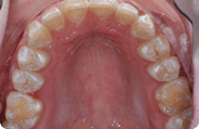 Patient 7.  Problem: Jaw position  Treatment type: Herbst appliance and braces 