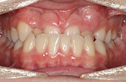 Patient 11.  Problem: Class 3 underbite  Treatment type: Braces and elastics  Treatment time: 20 months 