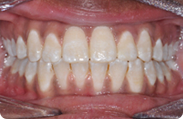 Patient 3.  Problem: Crowding  Treatment type: Braces & extractions 