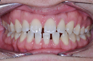 Patient 6.  Problem: Spacing  Treatment type: Invisalign® 