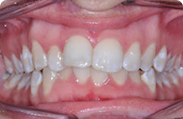 Patient 1.  Problem: Upper & lower crowding  Treatment type: Invisalign® 