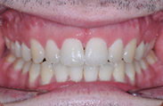 Patient 2.  Problem: Narrow arch  Treatment type: Braces, RME, extractions and surgery 