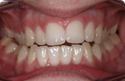 Patient 2.  Problem: Narrow arch  Treatment type: Braces, RME, extractions and surgery 