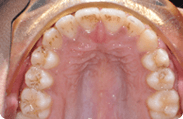 Patient 9.  Problem: Crowding and jaw position  Treatment type: Upper expander and braces 