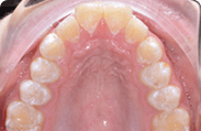 Patient 7.  Problem: Jaw position  Treatment type: Herbst appliance and braces 