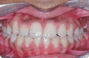 Patient 9.  Problem: Crowding and jaw position  Treatment type: Upper expander and braces 