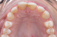 Patient 4.  Problem: Spacing in teeth  Treatment type: Braces 