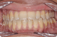 Patient 8.  Problem: Spacing and Jaw position  Treatment type: Braces, premolar extractions & surgery 