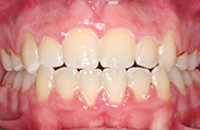 Patient 10.  Problem: Severe crowding, narrow upper jaw  Treatment type: Rapid Maxillary expansion and braces  Treatment time: 20 months 