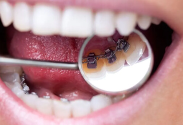 Lingual Braces Lingual Braces