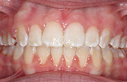 Patient 13.  Problem: Open bite and tongue thrust  Treatment type: U/L braces and tongue crib  Treatment time: 18 months 