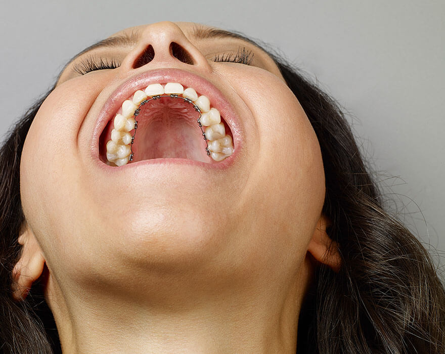  What are lingual braces?