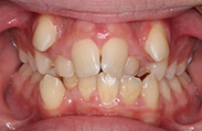 Patient 10.  Problem: Severe crowding, narrow upper jaw  Treatment type: Rapid Maxillary expansion and braces  Treatment time: 20 months 