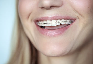 Ceramic braces Ceramic braces