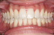 Patient 15.  Problem: Crowding and rotated teeth  Treatment type: U/L Invisalign®  Treatment time: 12 months 