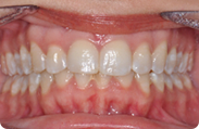 Patient 1.  Problem: Upper & lower crowding  Treatment type: Invisalign® 