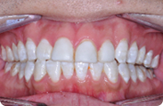 Patient 5.  Problem: Class 1 crowding  Treatment type: Invisalign® 