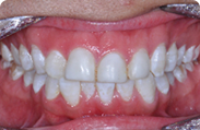 Patient 5.  Problem: Class 1 crowding  Treatment type: Invisalign® 