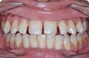 Patient 8.  Problem: Spacing and Jaw position  Treatment type: Braces, premolar extractions & surgery 