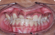 Patient 9.  Problem: Crowding and jaw position  Treatment type: Upper expander and braces 