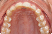 Patient 1.  Problem: Upper & lower crowding  Treatment type: Invisalign® 