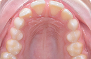 Patient 6.  Problem: Spacing  Treatment type: Invisalign® 