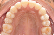 Patient 3.  Problem: Crowding  Treatment type: Braces & extractions 