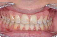 Patient 4.  Problem: Spacing in teeth  Treatment type: Braces 