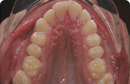 Patient 2.  Problem: Narrow arch  Treatment type: Braces, RME, extractions and surgery 