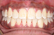 Patient 14.  Problem: Crowding and anterior crossbite  Treatment type: U/L Invisalign®  Treatment time: 18 months 