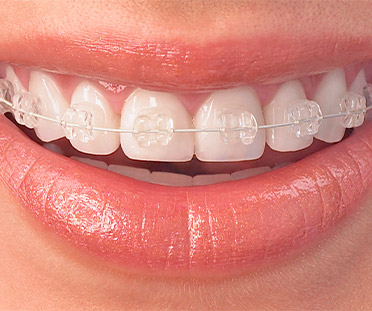 Ceramic braces