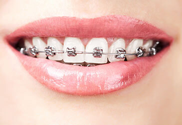 Metal braces Metal braces