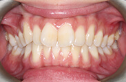 Patient 15.  Problem: Crowding and rotated teeth  Treatment type: U/L Invisalign®  Treatment time: 12 months 