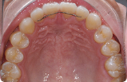 Patient 6.  Problem: Spacing  Treatment type: Invisalign® 