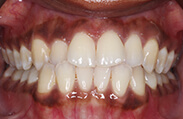 Patient 12.  Problem: Narrow arches and crowding  Treatment type: U/L Invisalign® aligners   Treatment time: 10 months 
