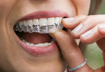 Invisalign® treatment Invisalign® treatment