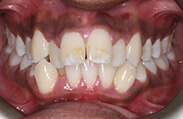 Patient 14.  Problem: Crowding and anterior crossbite  Treatment type: U/L Invisalign®  Treatment time: 18 months 