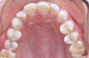 Patient 5.  Problem: Class 1 crowding  Treatment type: Invisalign® 