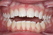 Patient 13.  Problem: Open bite and tongue thrust  Treatment type: U/L braces and tongue crib  Treatment time: 18 months 