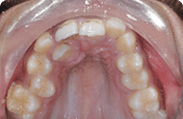 Patient 9.  Problem: Crowding and jaw position  Treatment type: Upper expander and braces 