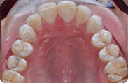 Patient 5.  Problem: Class 1 crowding  Treatment type: Invisalign® 