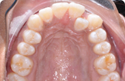 Patient 3.  Problem: Crowding  Treatment type: Braces & extractions 