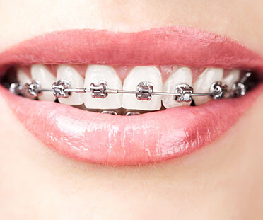 Metal braces