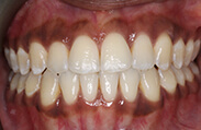 Patient 12.  Problem: Narrow arches and crowding  Treatment type: U/L Invisalign® aligners   Treatment time: 10 months 