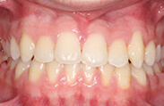 Patient 11.  Problem: Class 3 underbite  Treatment type: Braces and elastics  Treatment time: 20 months 