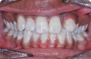 Patient 3.  Problem: Crowding  Treatment type: Braces & extractions 