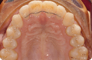 Patient 8.  Problem: Spacing and Jaw position  Treatment type: Braces, premolar extractions & surgery 