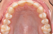 Patient 4.  Problem: Spacing in teeth  Treatment type: Braces 